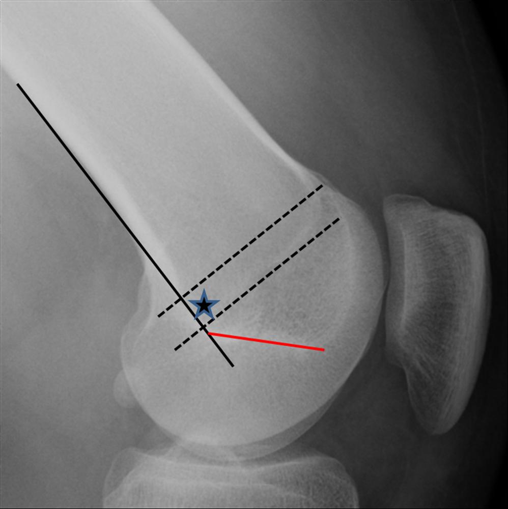 Patellar Instability Knee & Sports Orthobullets